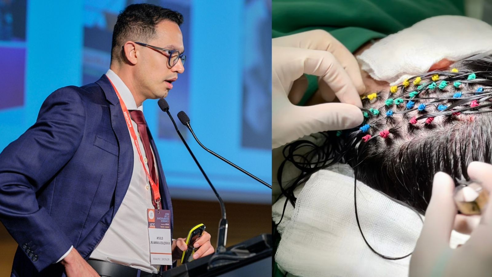 Dermatologista Elson Viana leva técnica premiada de transplante capilar a congressos na Europa e Ásia