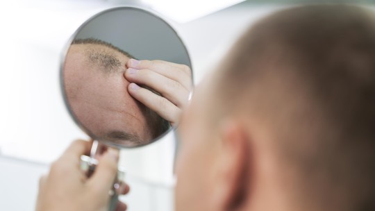 Alopecia areata e androgenética: veja sintomas, causas e tratamentos