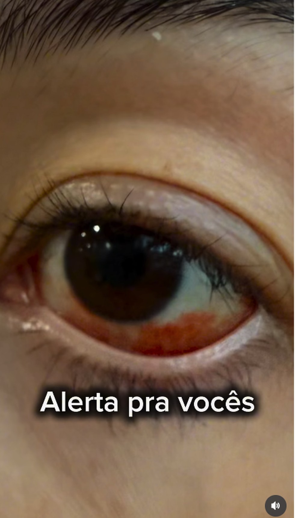 Imagem compartilhada pela influenciadora mostra o olho inchado e vermelho após o uso da lente vencida — Foto: Reprodução Instagram