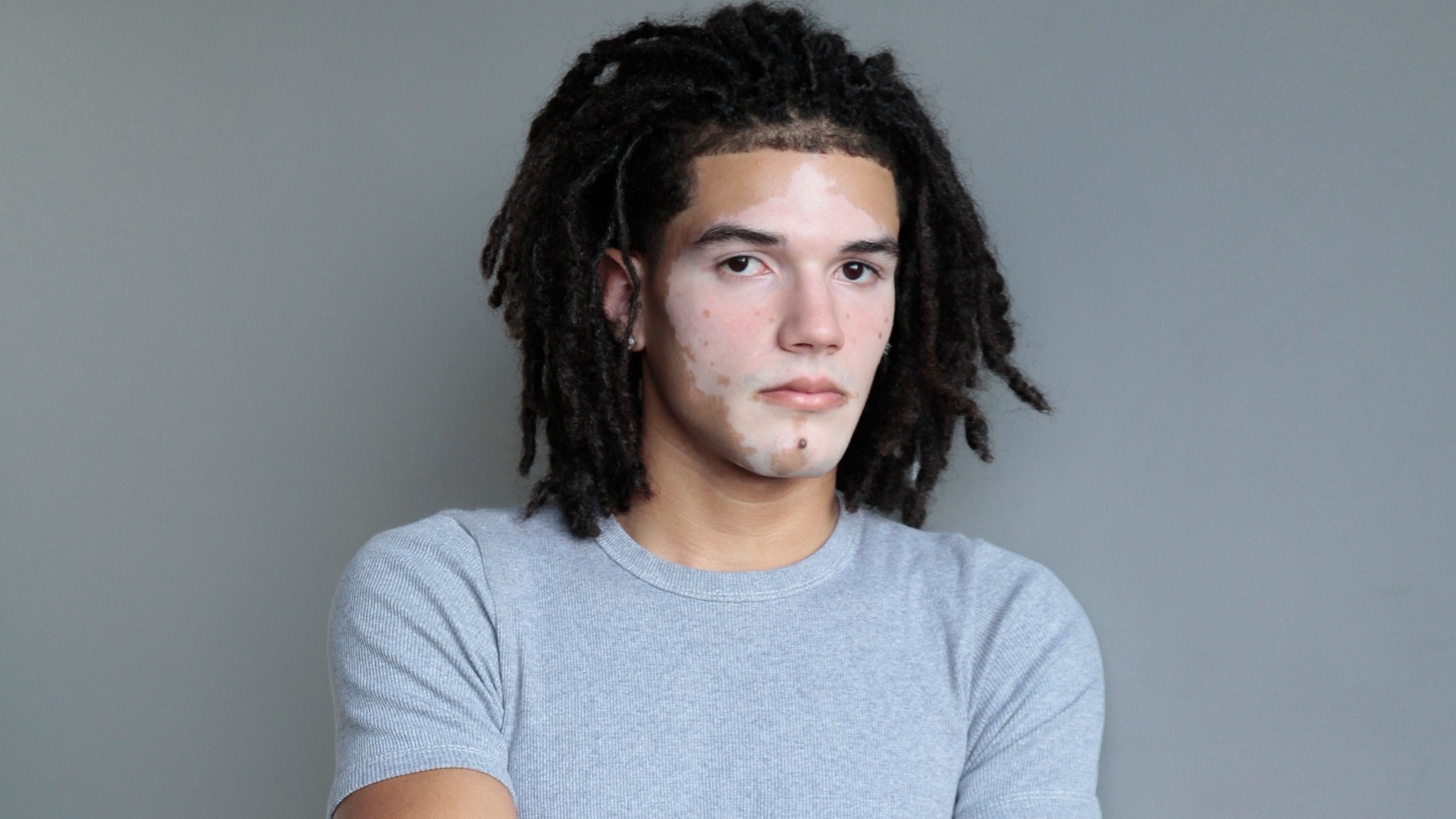 Conheça o jovem com vitiligo que estreia como modelo e quer ampliar referências de beleza - QTU Questões do Universo