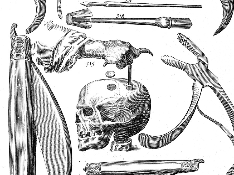 Trepanação: técnica usada em Lula data de quase 10 mil anos atrás; veja ...