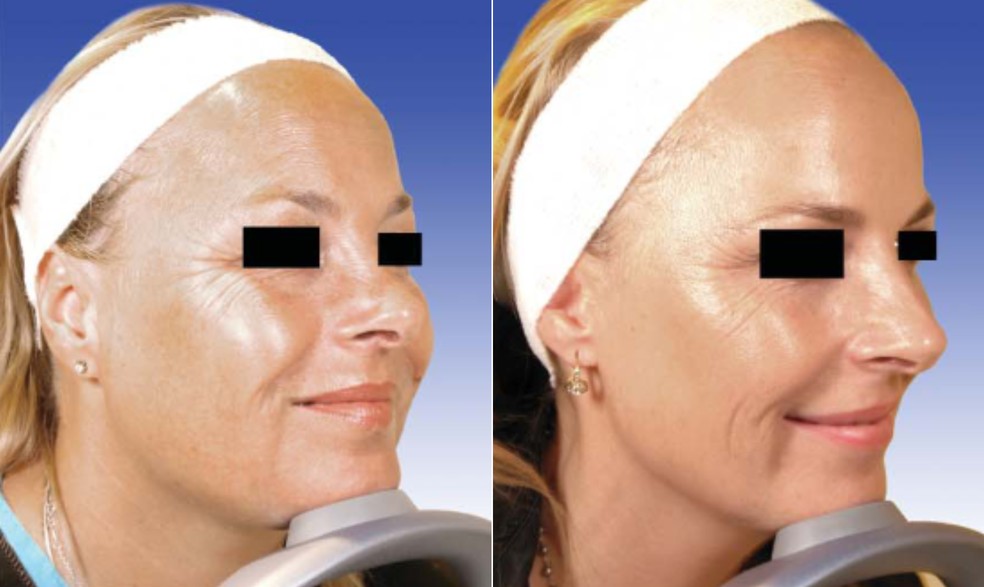 À esquerda, gêmea que realizou duas sessões de Botox em 13 anos. À direita, gêmea que realizou o procedimento anualmente. — Foto: Dermatologic Surgery