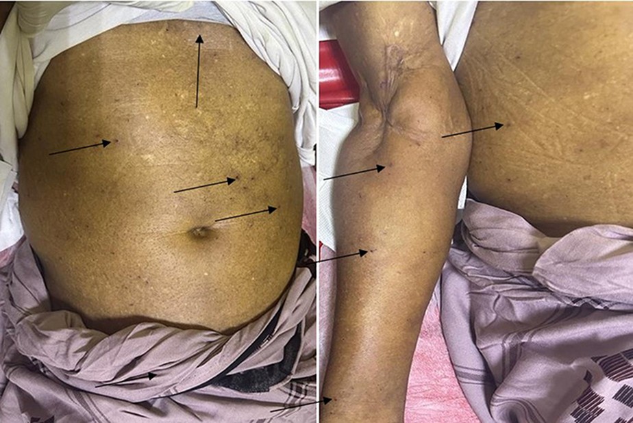 Homem sobrevive mesmo após sofrer falência múltipla de órgãos por picada de abelha