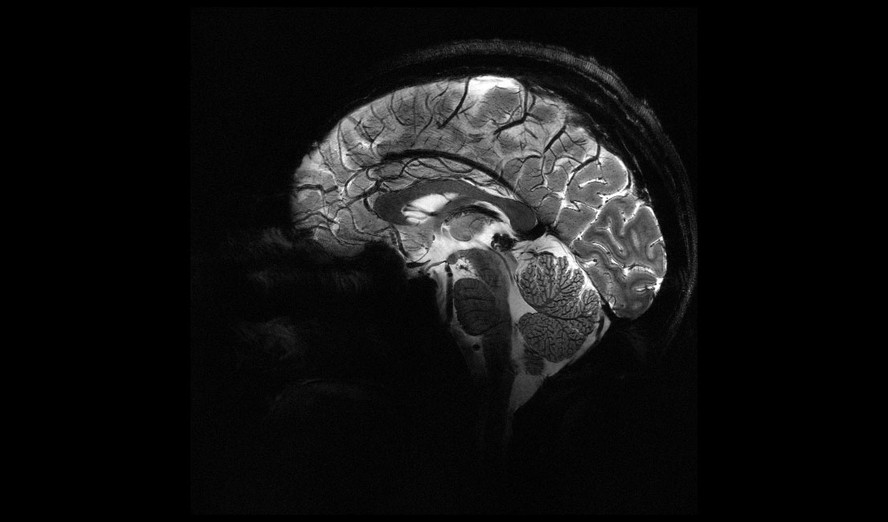 Imagem do Iseult Magneton 11.7 T MRI mostra cérebro humano.