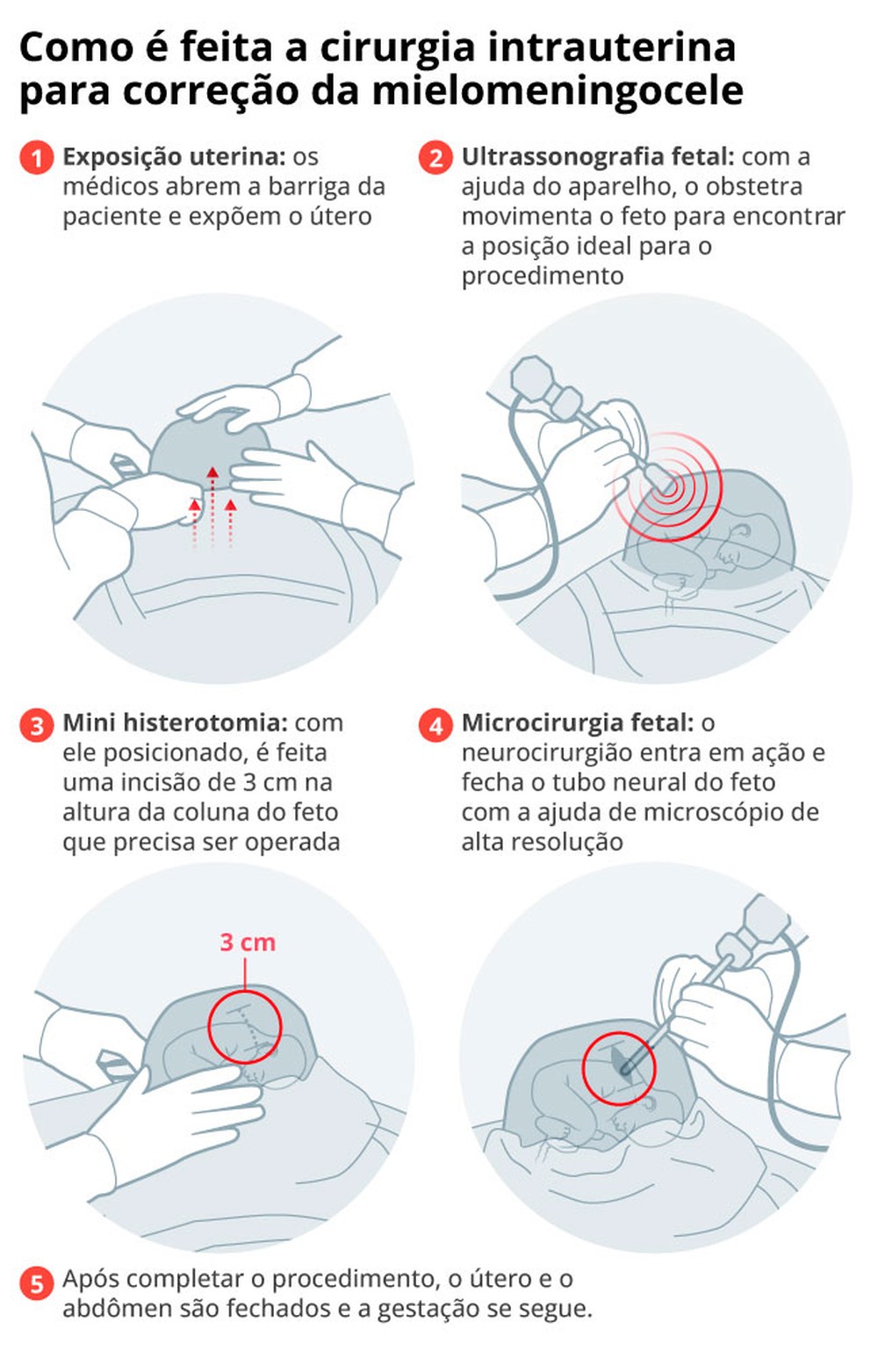 Vida nova antes de nascer: SUS do Rio trata má-formação ainda no útero