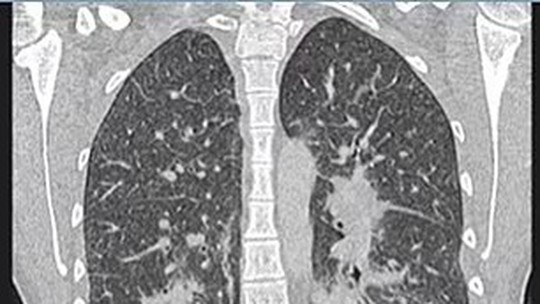 Menina de 19 anos é colocada em  respirador após cigarro eletrônico fazer seus pulmões parecerem 'vidros quebrados'