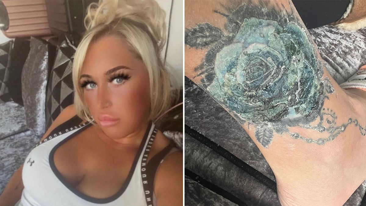 Mulher pode ter o pé amputado após ter infecção em tatuagem feita durante as férias na Turquia; entenda