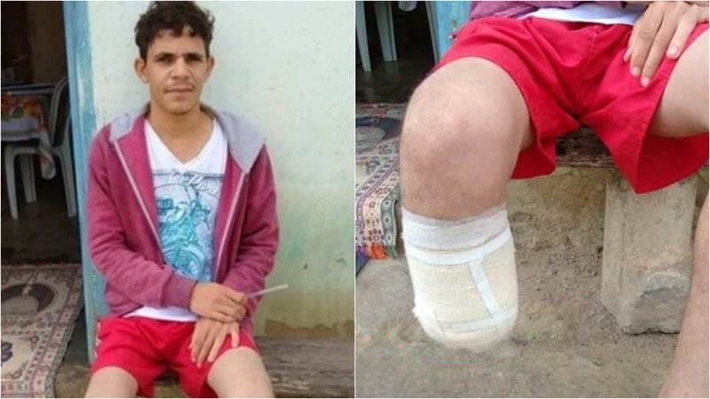 Servidor público da Bahia que amputou o próprio pé para tentar receber R$ 1,5 milhão teve membro encontrado dentro da mochila