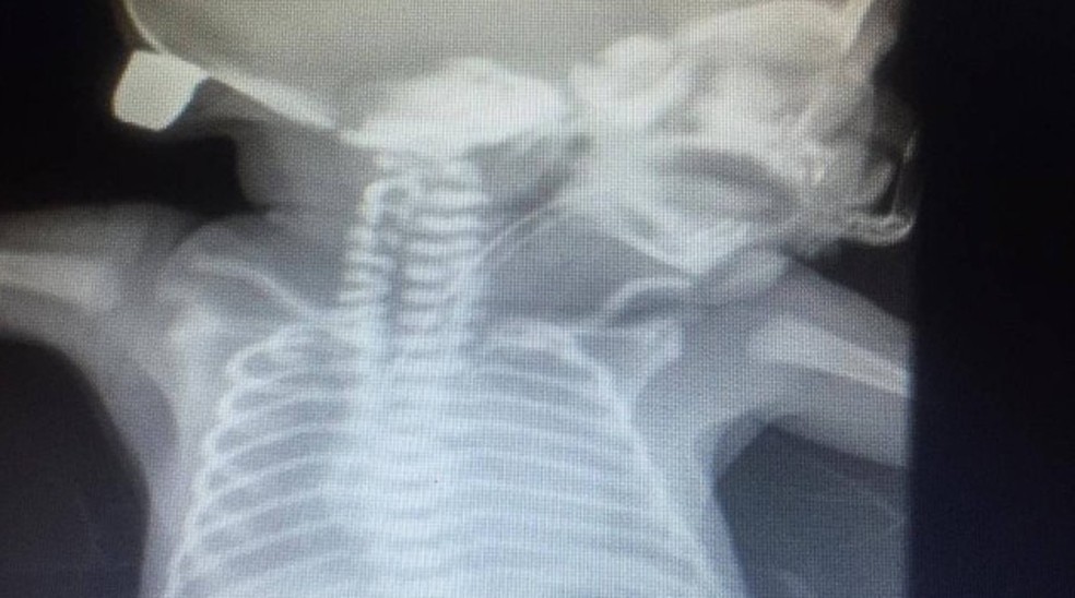 Imagem de raio-X mostra bala alojada na cabeça de bebê atingido na barriga da mãe, em 2019 — Foto: Reprodução