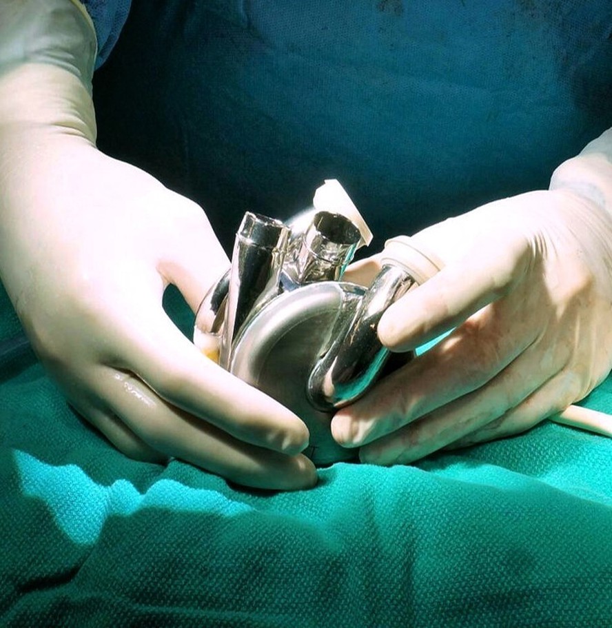 Cientistas implantam 1º coração totalmente artificial feito de titânio em paciente humano.