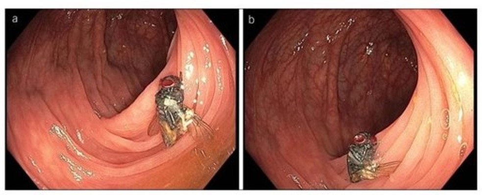 Médicos encontram mosca intacta em intestino de homem. — Foto: American Journal of Gastroenterology