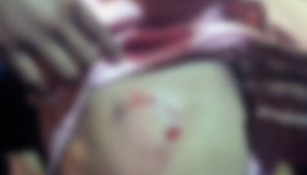 Criança de 7 anos é atacada por pitbull sem focinheira em Santa Teresa
