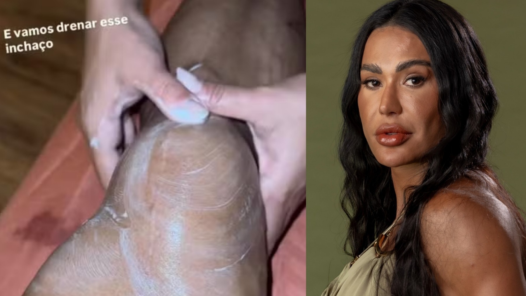 Joelho inchado de Gracyanne Barbosa levanta dúvida: quando o inchaço após exercício merece atenção? - QTU Questões do Universo