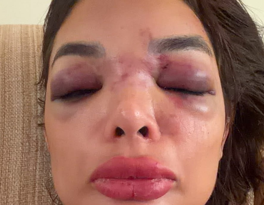 Empresário da Faria Lima é preso em flagrante por agredir mulher: 'Deixou  meu rosto deformado'