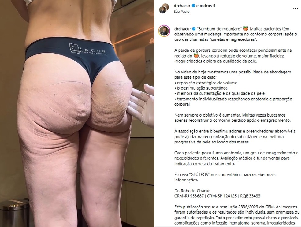 'Bumbum de Mounjaro' ganha repercussão após relatos de mudanças corporais extremas — Foto: Reprodução Instagram