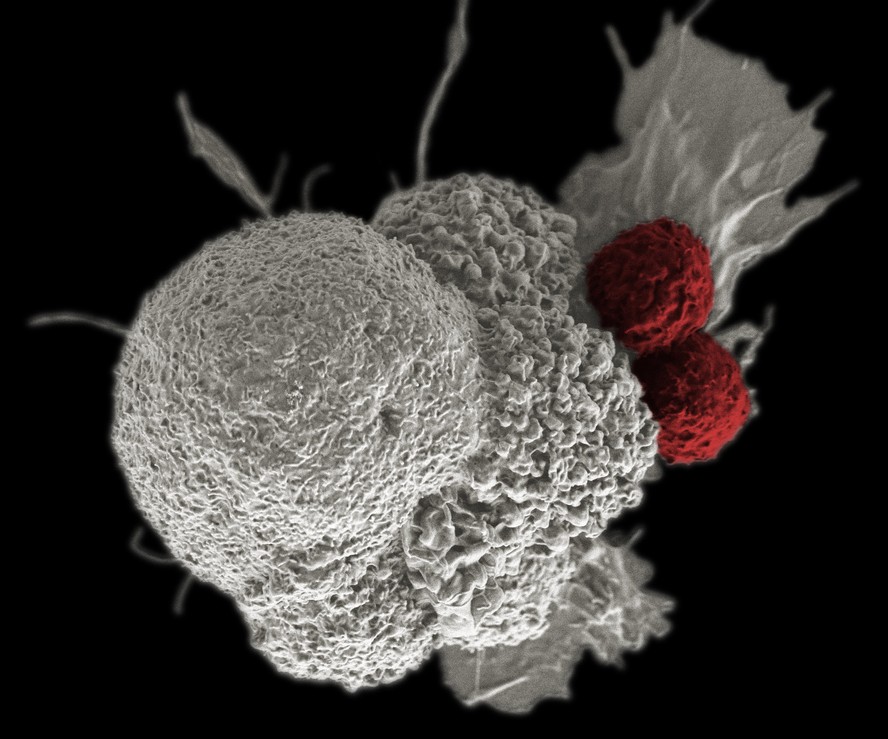 Célula de câncer é atacada por linfócitos T do sistema imunológico