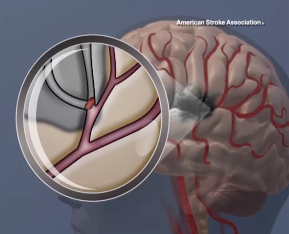 Novo comprimido reduz a chance de segundo AVC em 26%