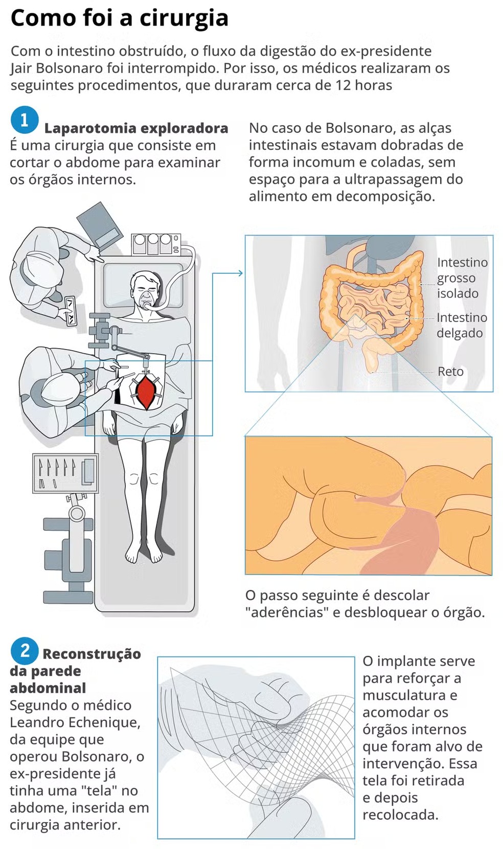 Entenda a cirurgia de Bolsonaro — Foto: Editoria de Arte