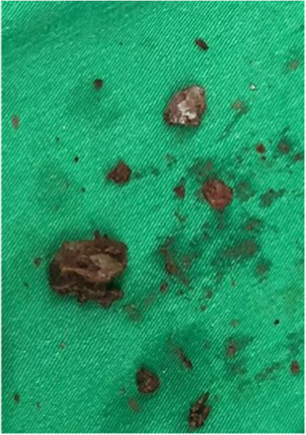 Pedra encontrada na vagina de mulher foi quebrada com laser — Foto: Reprodução/Urology Case Reports