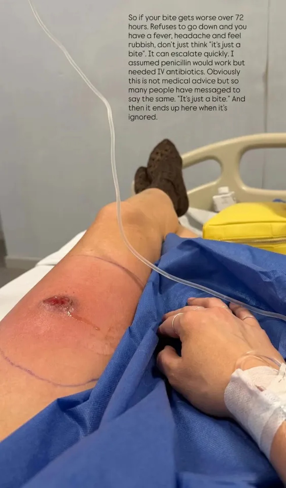 A influenciadora, autora e jornalista britânica Anna Whitehouse, conhecida nas redes sociais como “Mother Pukka”, foi internada após desenvolver sepse provocada por uma picada de aranha — Foto: Reprodução: Instagram