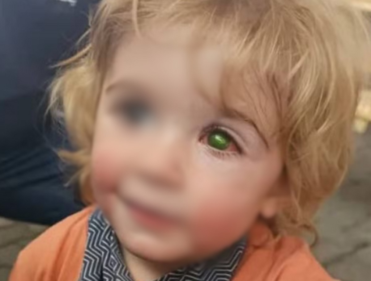 Menino de 2 anos perde a visão de um olho após beijo de pessoa com herpes labial