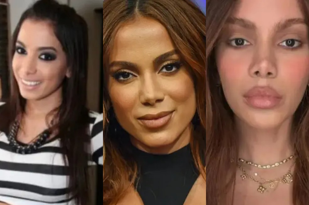 Anitta explicou sumiço e falou sobre procedimentos no rosto — Foto: Reprodução Instagram/TV Globo