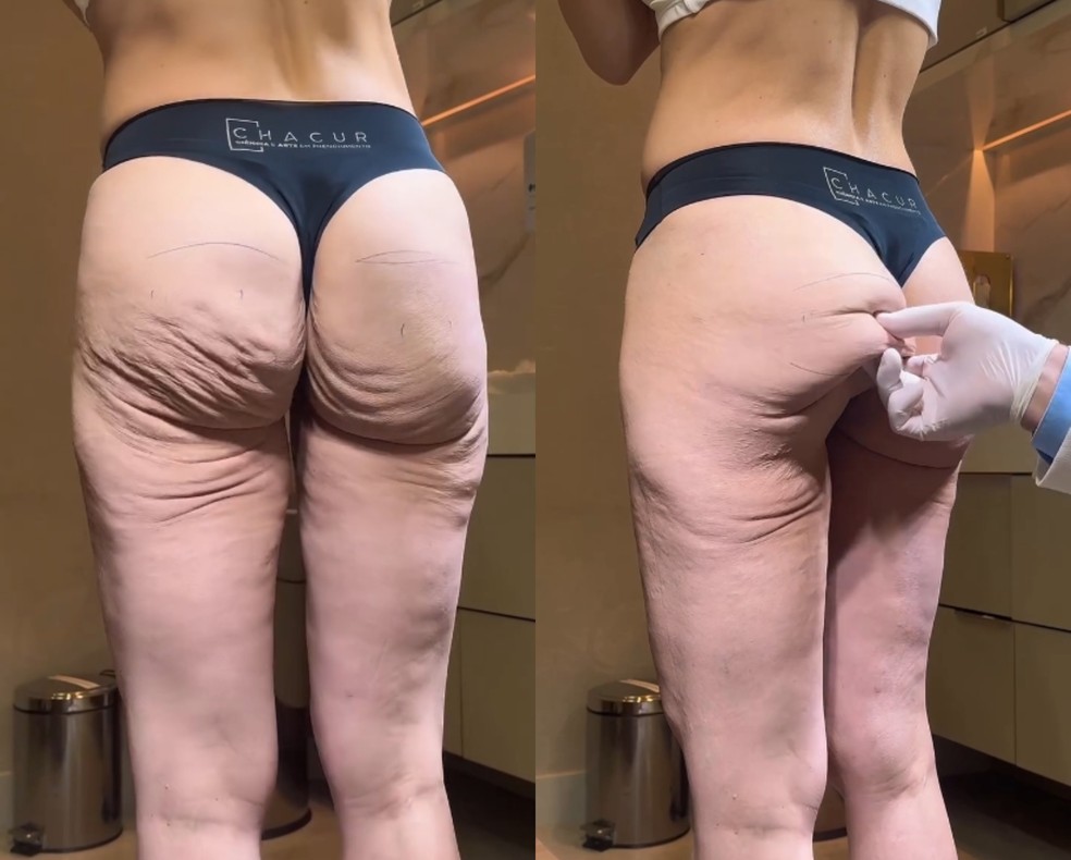 'Bumbum de Mounjaro' ganha repercussão após relatos de mudanças corporais extremas — Foto: Reprodução Instagram