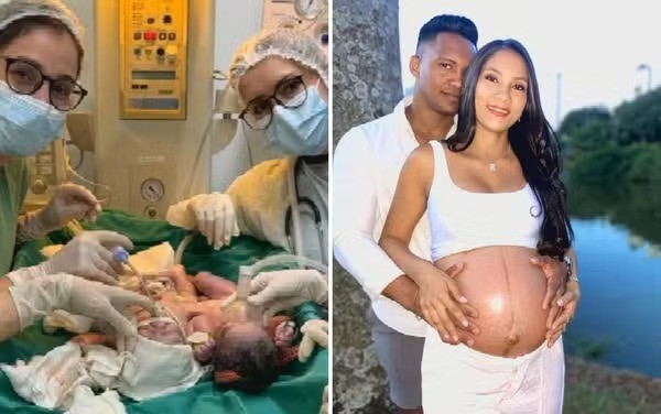 Bebês siameses de Goiás morrem após infecção intestinal grav