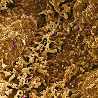 Partículas do vírus da varíola dos macacos (rosa) encontradas dentro do tecido de uma célula infectada (laranja).