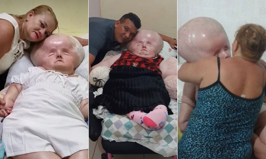 Hidrocefalia Antes E Depois