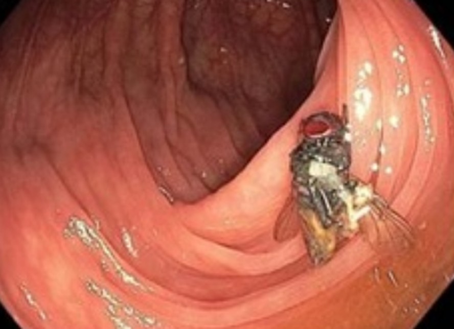 Mosca intacta estava no cólon do paciente