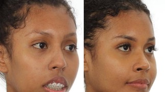 Giovanna Jacobina passou por uma cirurgia ortognática e rinoplastia — Foto: Reprodução/Instagram | Dra. Katyuscia