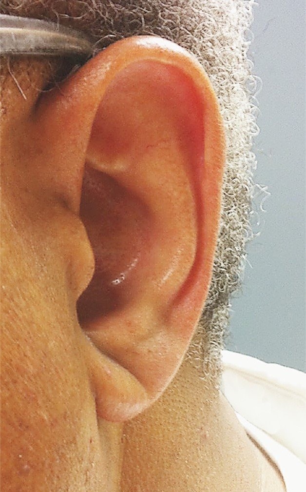 Sua orelha pode prever um infarto?