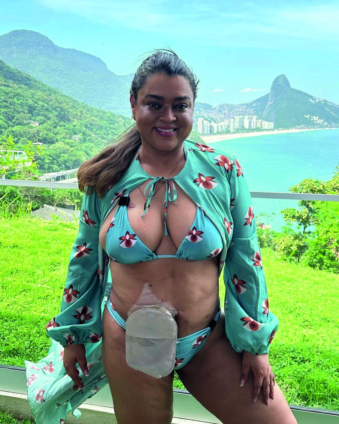 Britta Gill com bolsa de ileostomia – Foto: Arquivo pessoal