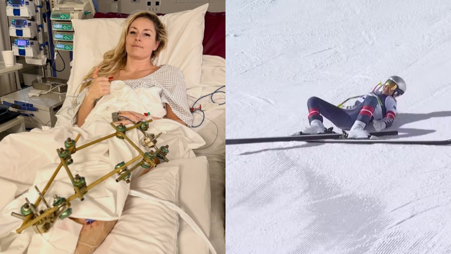 Lindsey Vonn publica foto após terceira cirurgia, atleta se lesionou durante competição nos Jogos Olímpicos de Inverno 2026