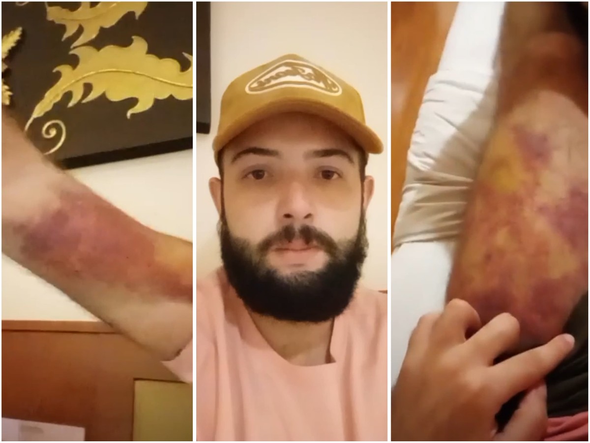 Brasileiro traficado em Mianmar mostra hematomas após espancamento com cassetete durante fuga; veja vídeo - Portais