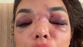 Empres&aacute;rio da Faria Lima &eacute; preso em flagrante por agredir mulher: &lsquo;Deixou meu rosto deformado&rsquo;
