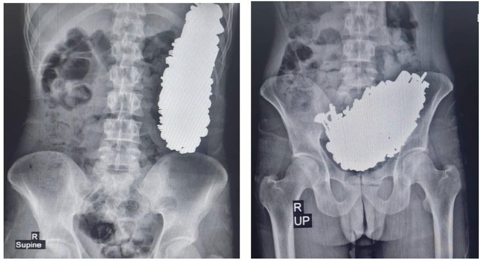 Médicos retiram mais de 450 objetos de metal de estômago de homem no Irã — Foto: Reprodução
