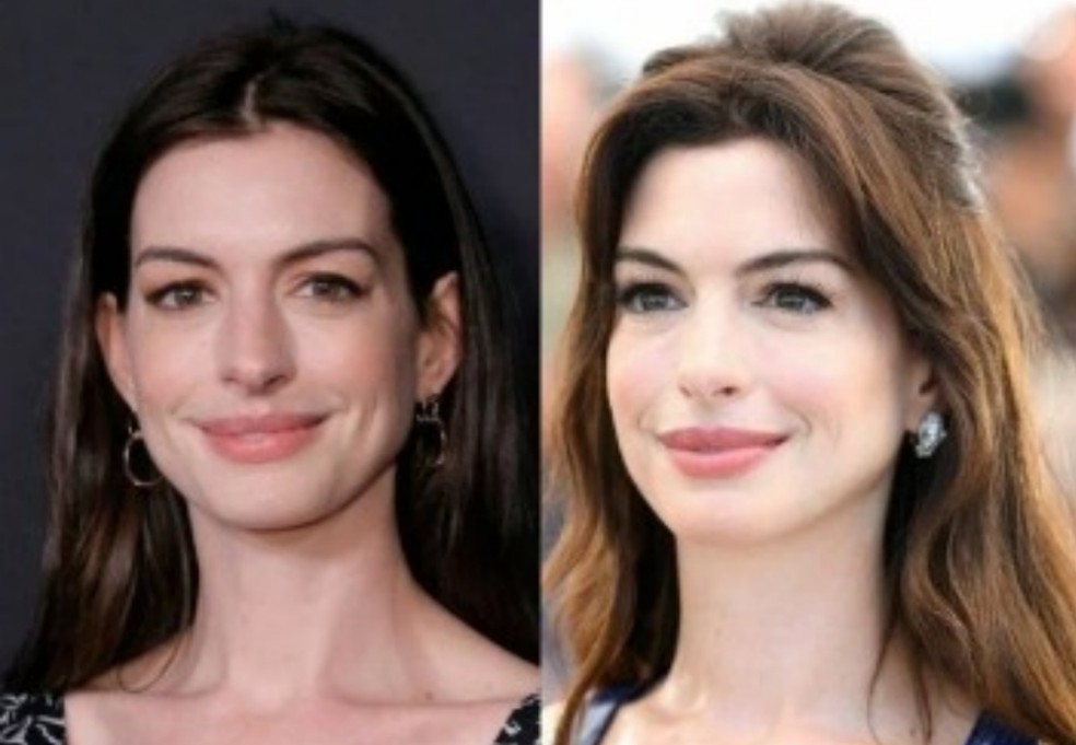Before and after procedures performed by Anne Hathaway — Photo: Getty Images