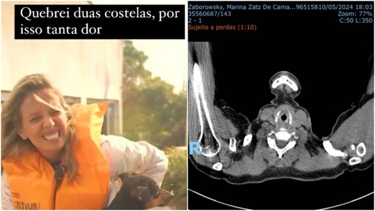 Luisa Mell se afasta de resgates de animais no RS após quebrar costelas: 'Podia ter perfurado um órgão'