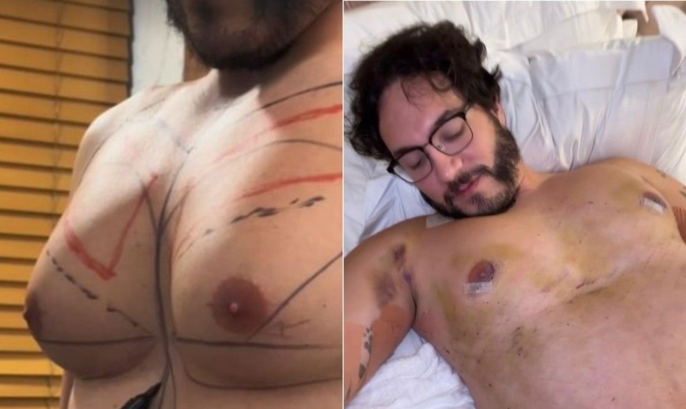 Antes e depois do procedimento de ginecomastia realizado pelo ex-BBB Eliezer — Foto: Arte/Reprodução