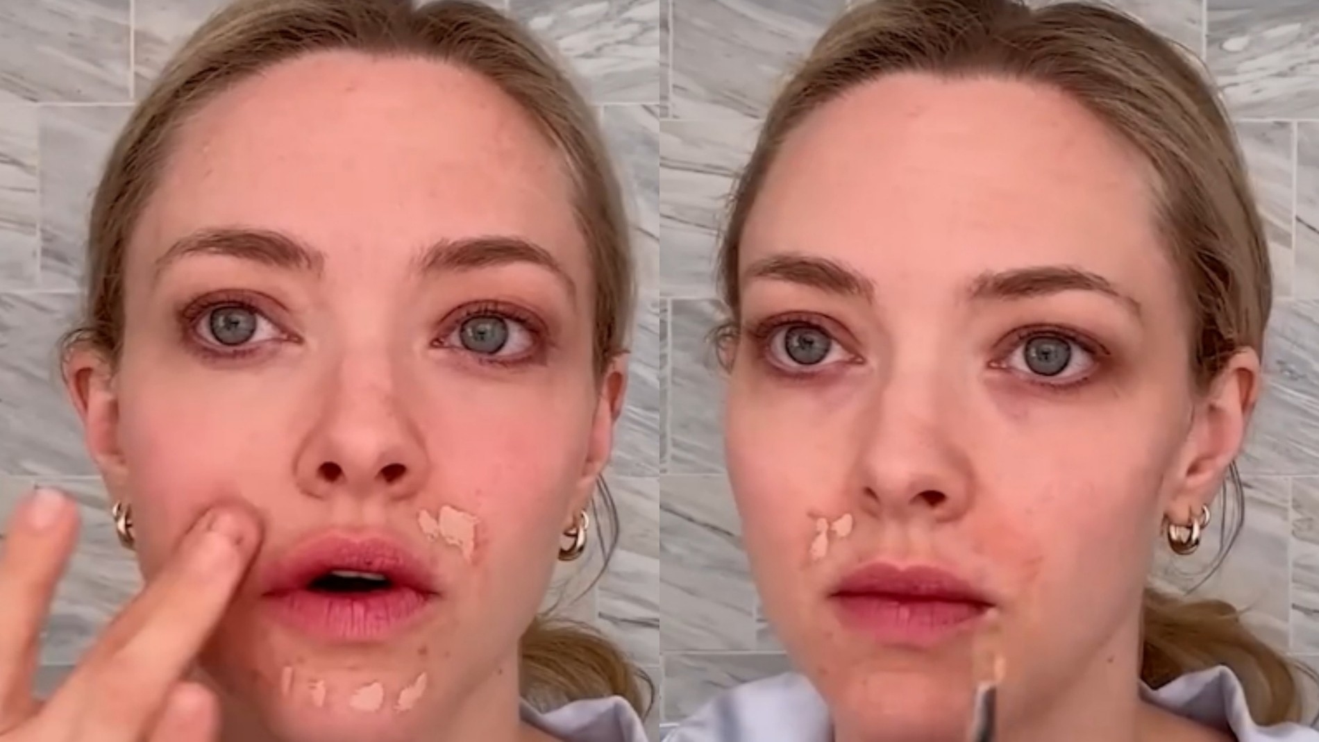 Amanda Seyfried tem uma condição de pele que pode ser confundida com acne - Foto