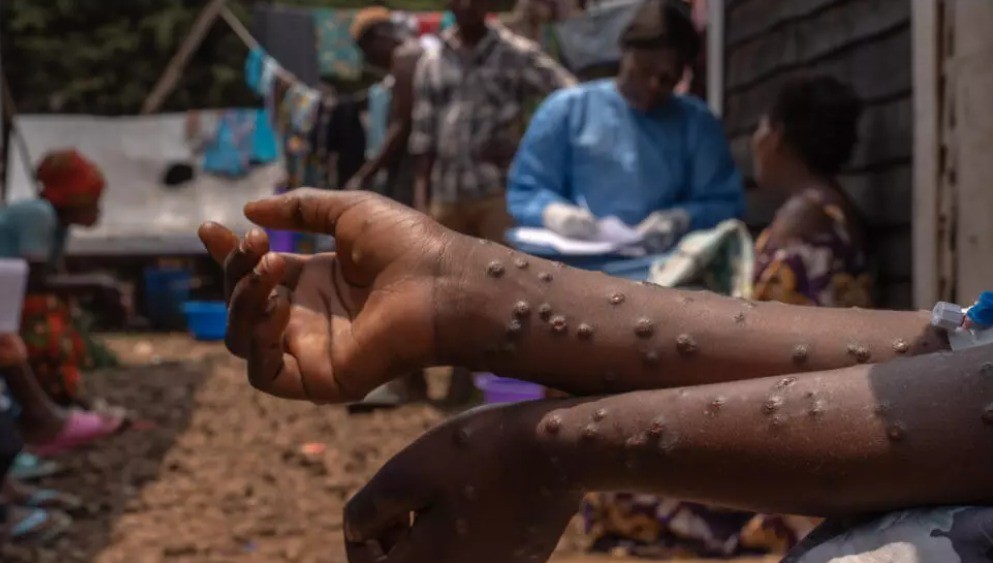 Reino Unido registra primeiras transmissões locais de mpox na Europa