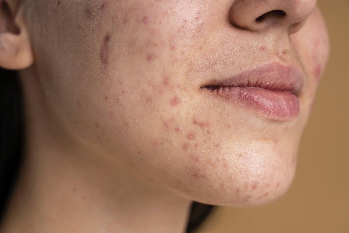 Novo tratamento para acne: cientistas alteram bact&eacute;rias da pele que atacam espinhas; entenda