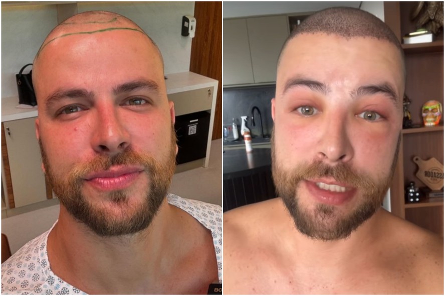 Cicatrizes quase imperceptíveis e resultado natural: como funciona transplante capilar feito pelo ex-BBB Gustavo Marsengo
