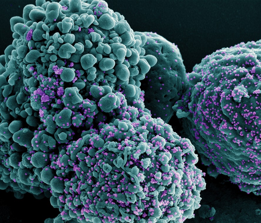Células humanas (azul) sendo infectadas pelo coronavírus (partículas roxas).