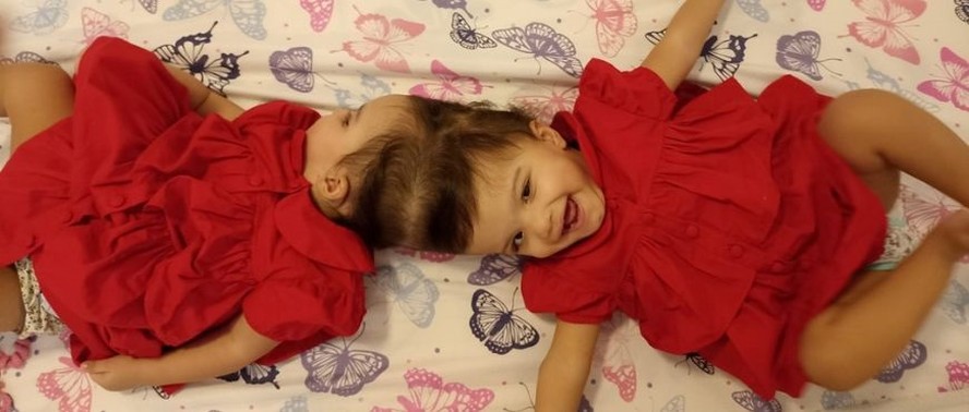 Allana e Mariah, de 2 anos e oito meses, que foram separadas na quarta cirurgia, que durou cerca de 27 horas