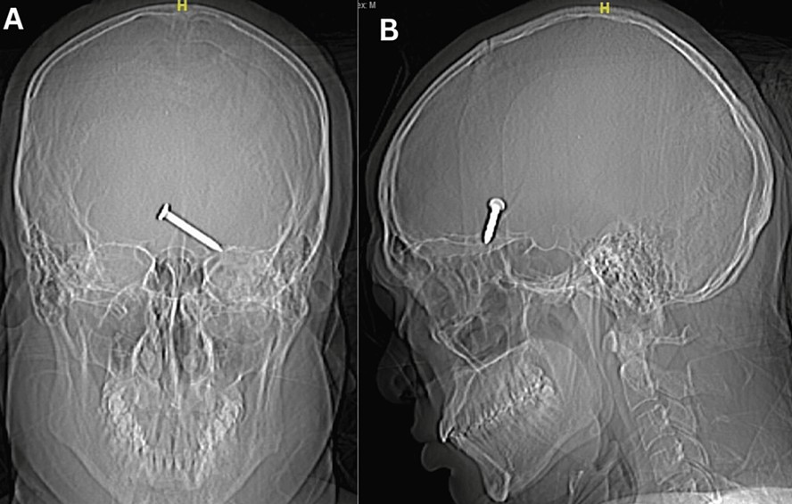 Radiografia simples de crânio, incidência anteroposterior (A) e perfil (B), evidenciando corpo estranho metálico semelhante a um prego.