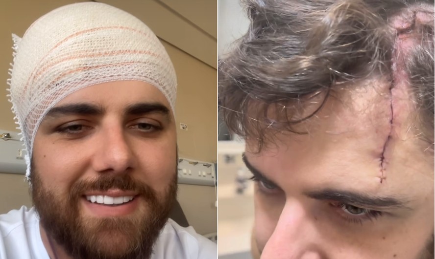 Zé Neto mostra os pontos na cabeça após acidente em quadriciclo