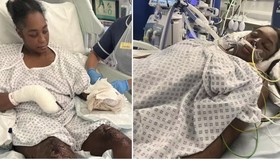 Mulher tem pernas e braço amputados após dar à luz gêmeos na Inglaterra: 'Vida de cabeça para baixo'